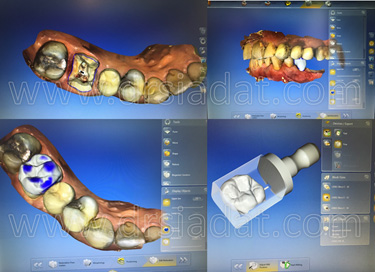 سیستم طراحی روکش دندان
