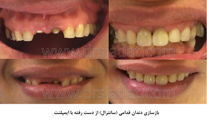 بازسازی دندان قدامی