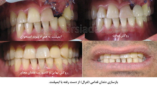 بازسازی دندان قدامی با ایمپلنت