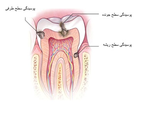 ترمیم دندان های طبیعی