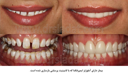 بازسازی دندانها