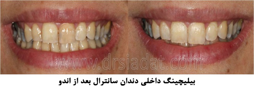 بیلیچینگ داخلی دندان سانترال بعد از اندو