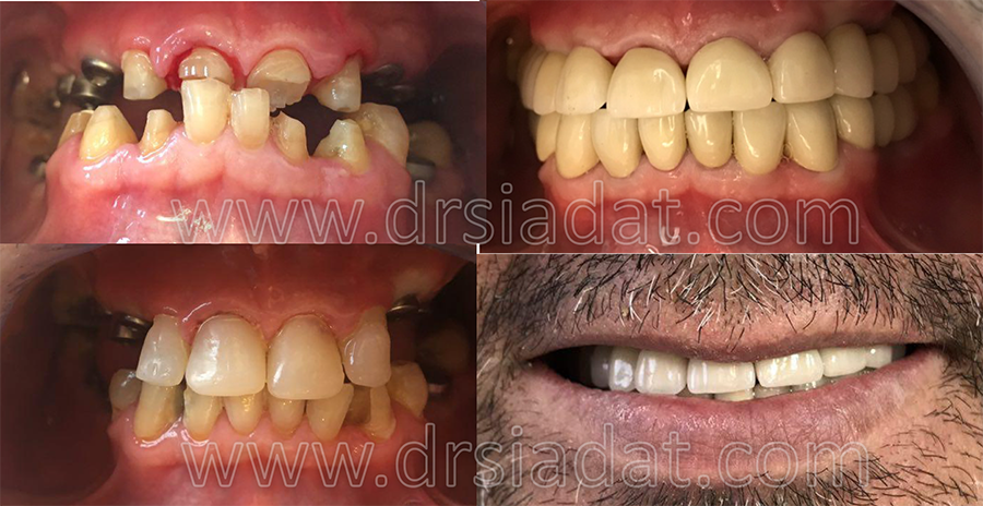 بیمار دارای سایش دندانهای قدامی، بازسازی دندانهای خلفی با ایمپلنت و دندانهای قدامی با PFM