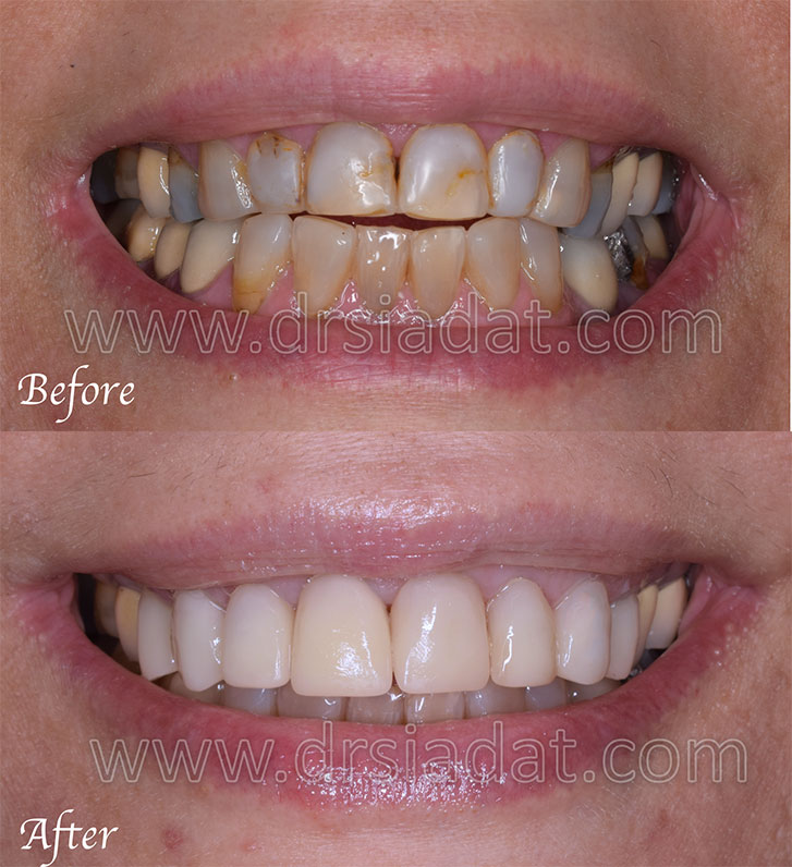 بیمار دارای سایش دندانهای قدامی، بازسازی دندانهای خلفی با ایمپلنت و دندانهای قدامی با PFM